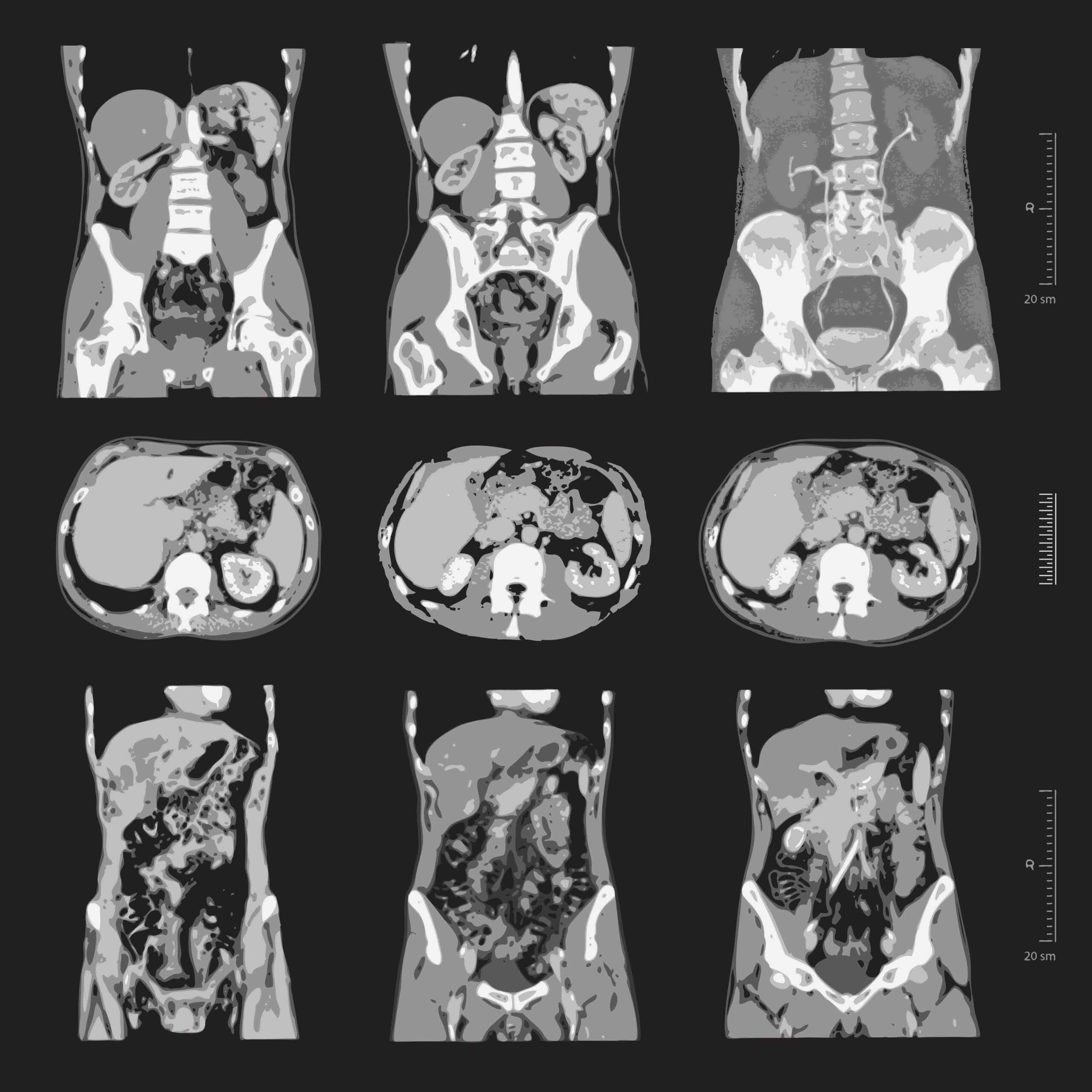 MRI 골반저근